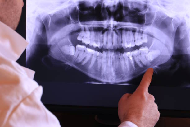 Best Emergency Wisdom Teeth Removal in Northville, MI